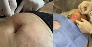 رفع چین و چروک و افتادگی پوست صورت و بدن با اندولیفت
